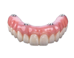 All on 4 implants Mexico